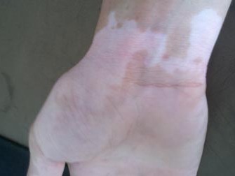 白癜风图片 白癜风图片