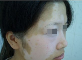 白癜风图片 白癜风图片