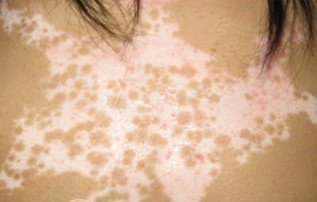 白癜风图片 白癜风图片