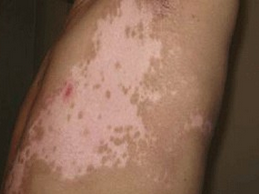 白癜风图片 白癜风图片