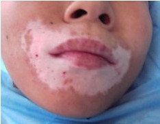 白癜风图片 白癜风图片